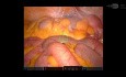 Resección robótica del colon sigmoide para la diverticulitis recurrente