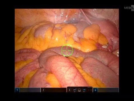 Resección robótica del colon sigmoide para la diverticulitis recurrente