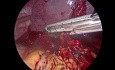Esplenectomía laparoscópica tras rotura esplénica espontánea