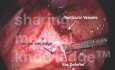 Imagen de cirugía TAPP de una hernia