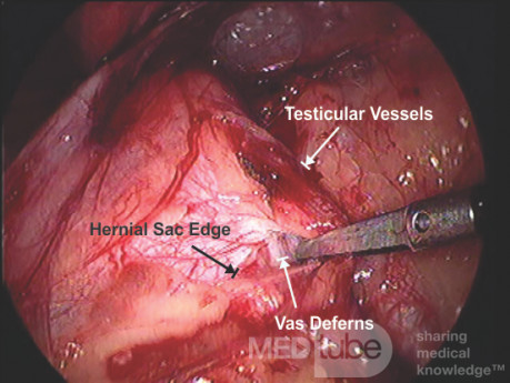 Imagen de cirugía TAPP de una hernia