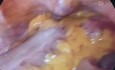 Hemicolectomia izquierda en un tumor de colon descendente obstructivo