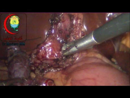 Si el conducto cístico es corto y se impacta un cálculo en el cuello de la vesícula biliar