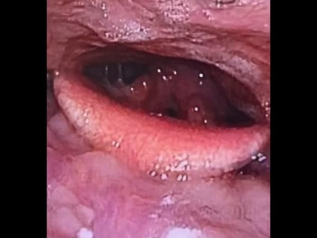 Leucoplasia bilateral de las cuerdas vocales con signos de reflujo laringofaríngeo