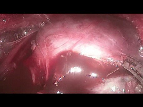 TOETVA - Tiroidectomía Endoscópica Transoral, Abordaje Vestibular (TETOAV)