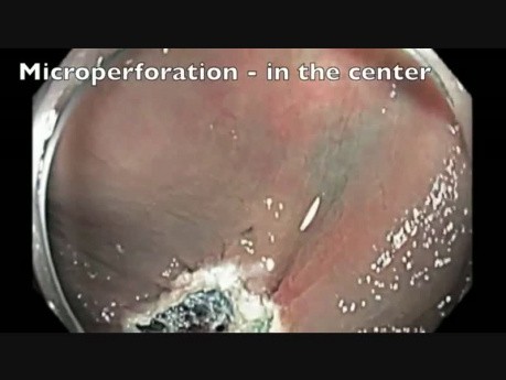 Perforación del colon tras RME - F