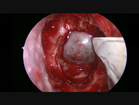 Extirpación endoscópica transesfenoidal de adenoma hipofisario