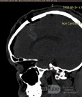 Estirpación de cavernoma subcortical 