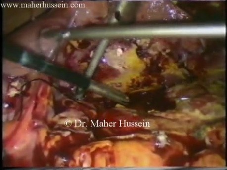 Úlcera péptica perforada - tratamiento laparoscópico