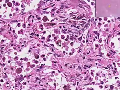 Neumonía con organización criptogénica - histopatología - pulmón