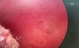 Quiste intramiometrial (adenomiosis)