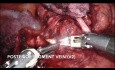 Segmentectomía S2 (robótica)