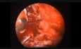 Escisión endoscópica del schwannoma orbitario