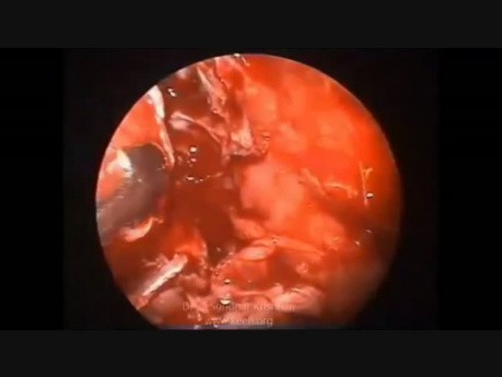 Escisión endoscópica del schwannoma orbitario
