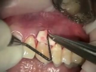 Implantes de colágeno - esperanza de cirugía plástica periodontica