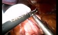 Colocación de banda gástrica ajustable por laparoscopia