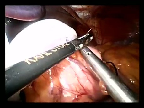 Colocación de banda gástrica ajustable por laparoscopia