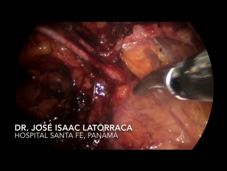 Laparoscopia con técnica transabdominal preperitoneal (TAPP) de hernia recurrente