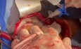 Operación de quiste hidatídico cardíaco
