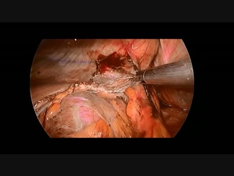 Reparación laparoscópica de hernia diafragmática izquierda en niño de 12 años