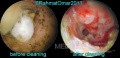 Otomicosis antes y después de la limpieza del oído