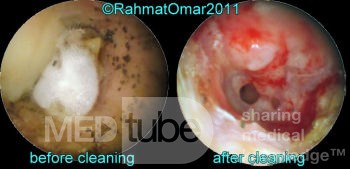 Otomicosis antes y después de la limpieza del oído