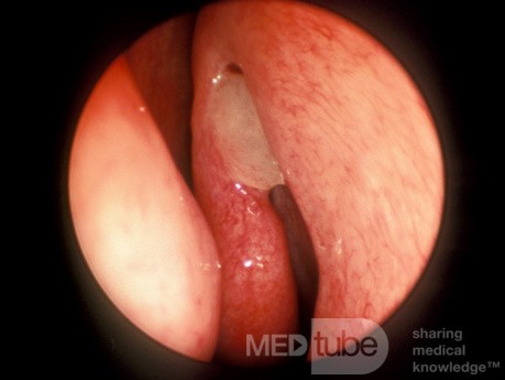 Pólipo nasal centinela [izquierda]