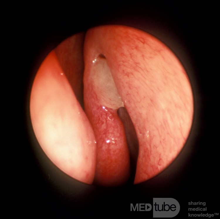 Pólipo nasal centinela [izquierda]