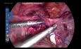 Uterolisis laparoscópica - Parte 2