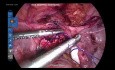 Uterolisis laparoscópica - Parte 2
