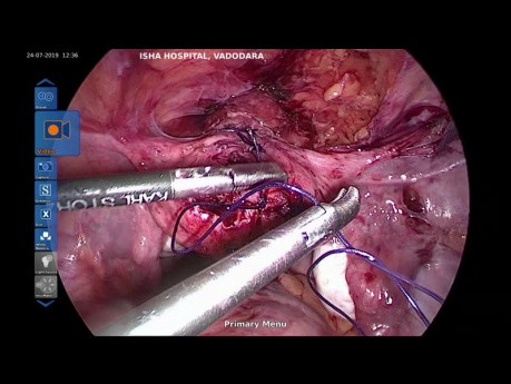 Uterolisis laparoscópica - Parte 2