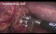 Nefrectomía derecha radical laparoscópica