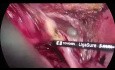 Resección multivisceral laparoscópica para el cáncer de sigmoide cT4 avanzado 