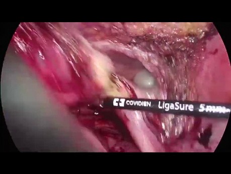 Resección multivisceral laparoscópica para el cáncer de sigmoide cT4 avanzado 