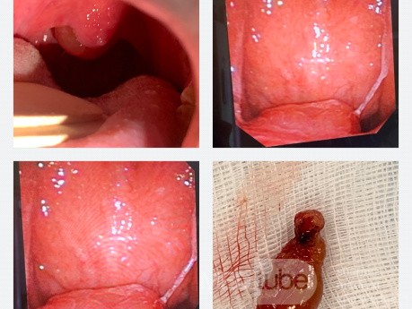 Masa del paladar blando (rinosporidiosis)