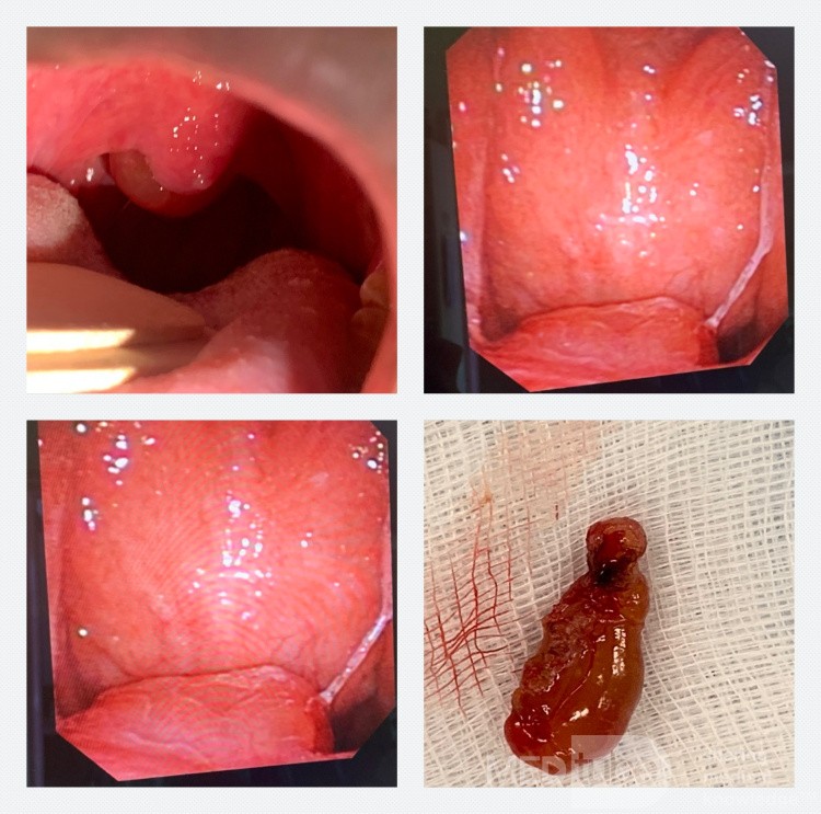 Masa del paladar blando (rinosporidiosis)