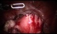 Miomectomia, 3 puertos