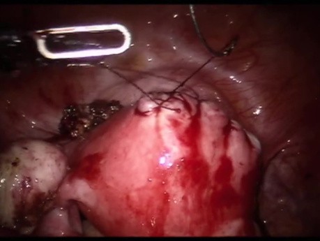 Miomectomia, 3 puertos
