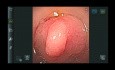 Gastroscopio desechable versus gastroscopio reutilizable: un ensayo prospectivo aleatorizado de no inferioridad