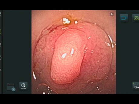 Gastroscopio desechable versus gastroscopio reutilizable: un ensayo prospectivo aleatorizado de no inferioridad