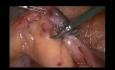 Mini apendicectomía
