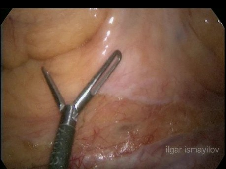 EMT laparoscópica, resección interesfinteriana parcial para el cáncer de recto distal