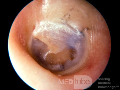 Tubo azul de ventilación en el oído medio