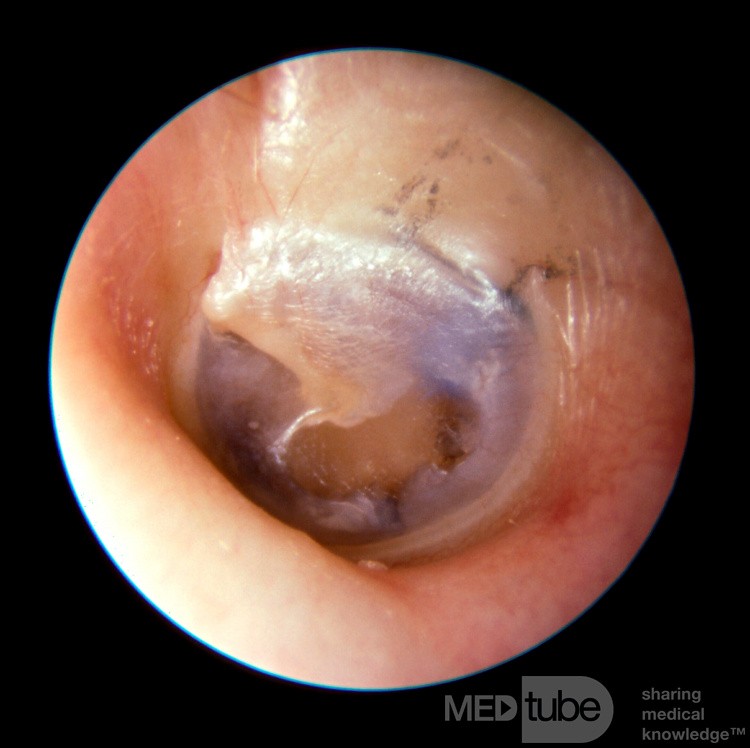 Tubo azul de ventilación en el oído medio