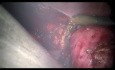 Histerectomía laparoscópica, 2 puertos