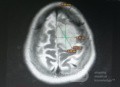 Planificación quirúrgica con neuronavegador en paciente con lesión de masa intracraneal. Glioma de alto grado.