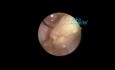 Polipectomía histeroscópica en un caso de sangrado posmenopáusico