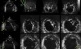 No compactación del ventrículo izquierdo en ecocardiografía 3D, Video nr 2