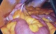 Prawostronna hemikolektomia + cholecystektomia laparoskopowa