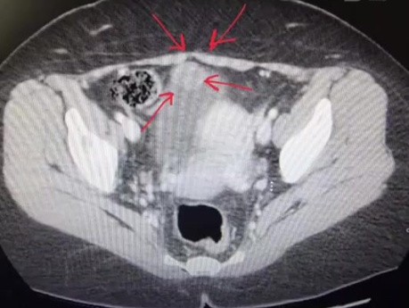 Cistectomía parcial laparoscópica para masa uracal